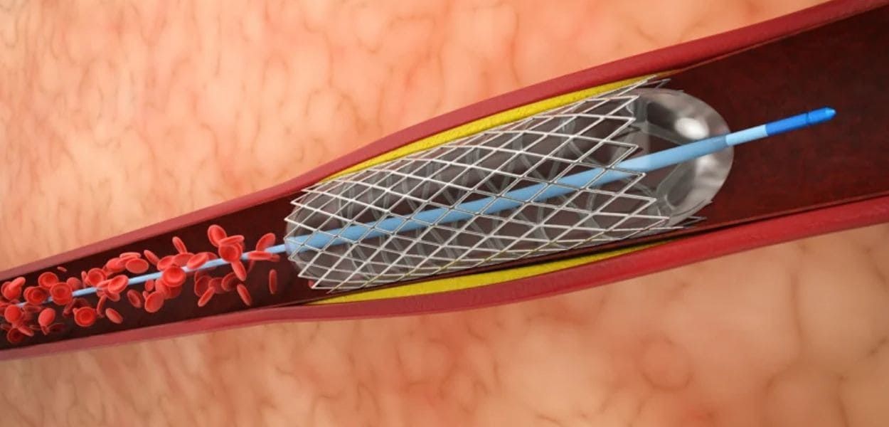 angioplasty.jpg