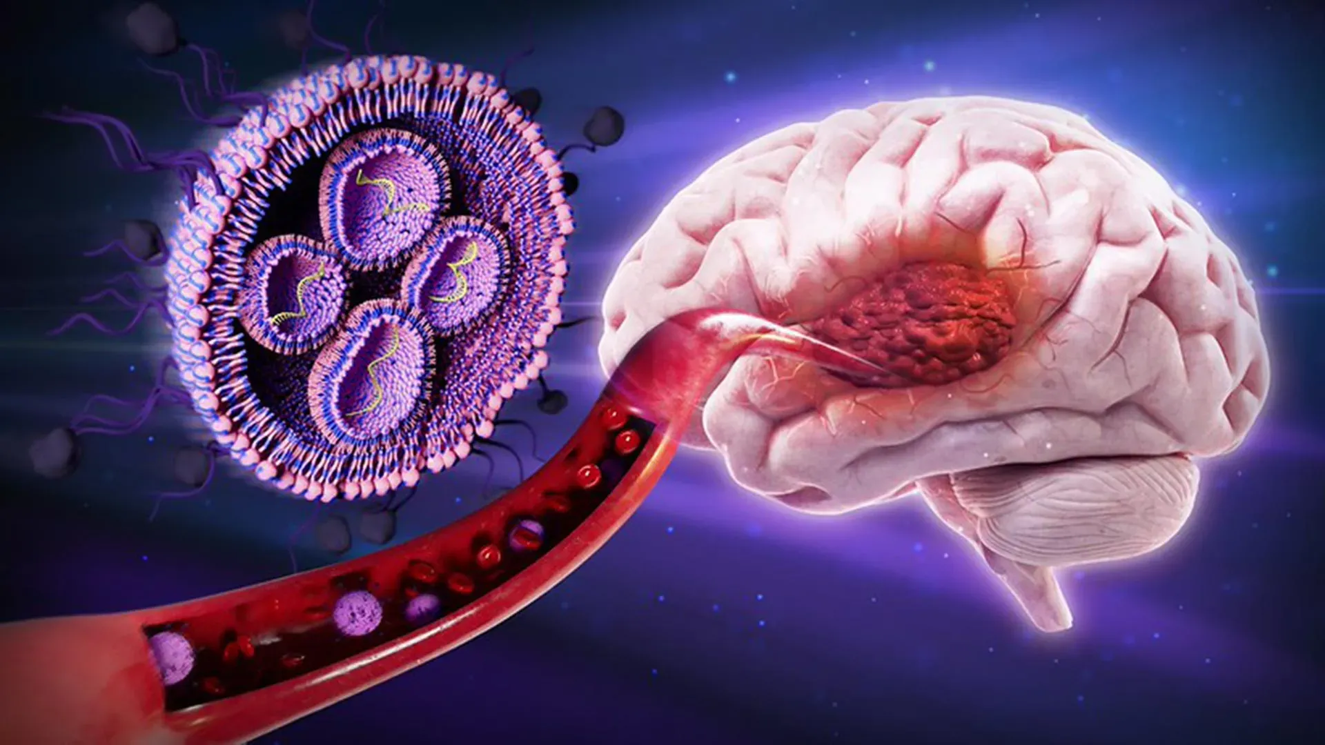 Glioblastoma Cancer Treatment