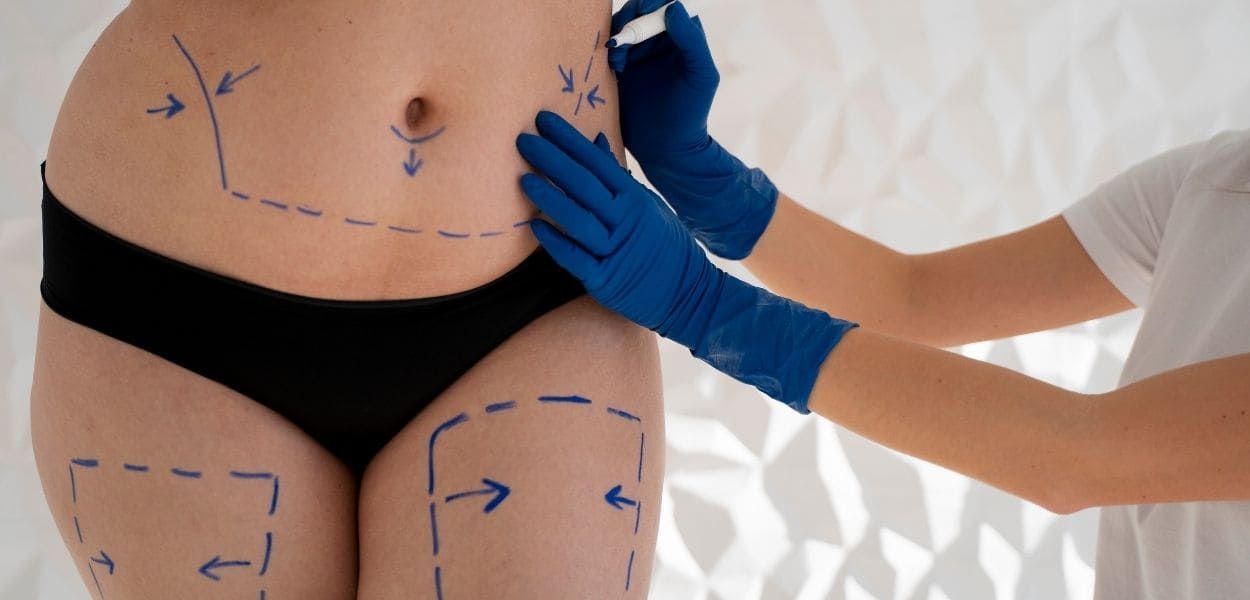 liposuction.jpg