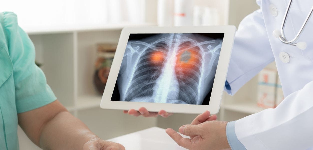lung-cancer.jpg