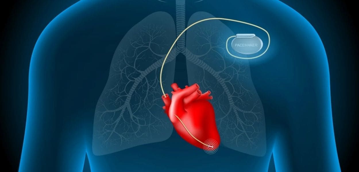 pacemaker.jpg