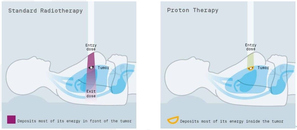 proton-therapy.jpg
