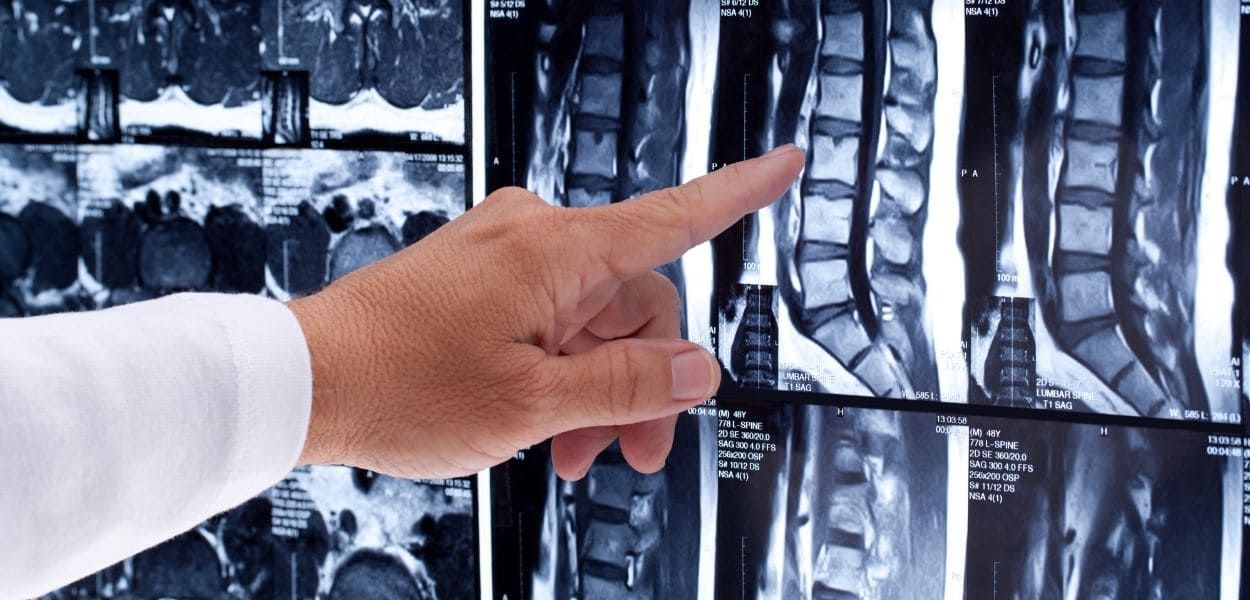 spine tumor.jpg